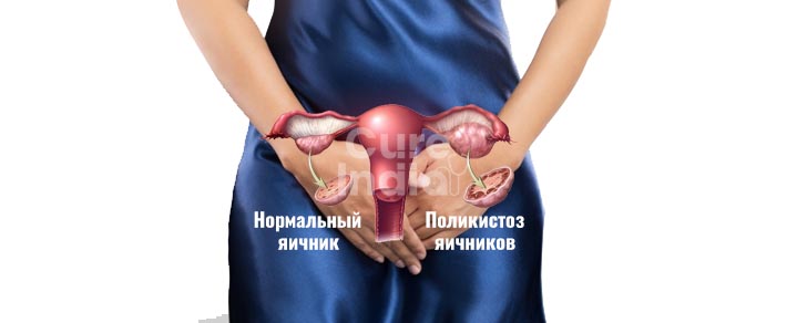 диагностика бесплодия у женщин, лечение бесплодия у женщин